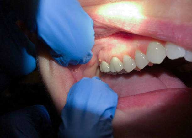 Best Emergency Dental Care for Broken or Chipped Teeth in Leakesville, MS